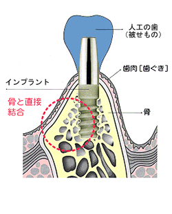 implant-4.png