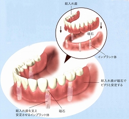 マグネットデンチャー.jpg