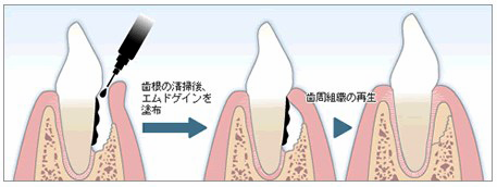 歯1-2.png
